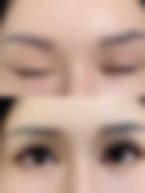 埋线双眼皮后植睫毛的时间