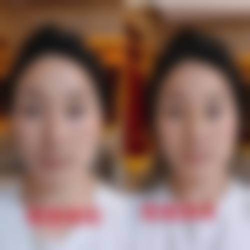 {耳软骨隆鼻可以取出来恢复原来的样子吗？鼻梁山根基本复原，鼻头或有轻微变形