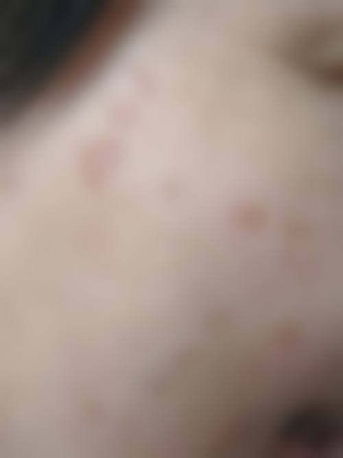 {涂什么可以淡化疤痕黑色素？氢醌乳膏、积雪苷霜软膏等药膏及激光可改善