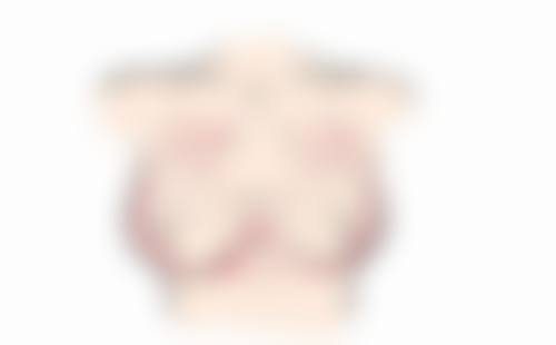 隆胸的假体凸度差异