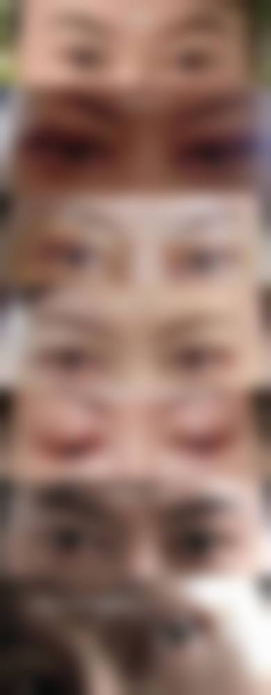 割双眼皮术后 2 - 4 周忌口调整期
