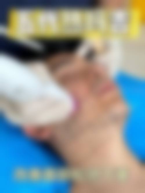 低能量射频刺激