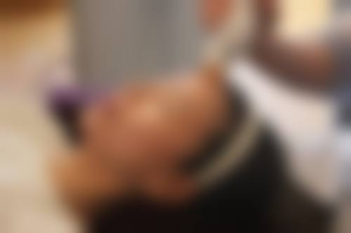 透明质酸填充
