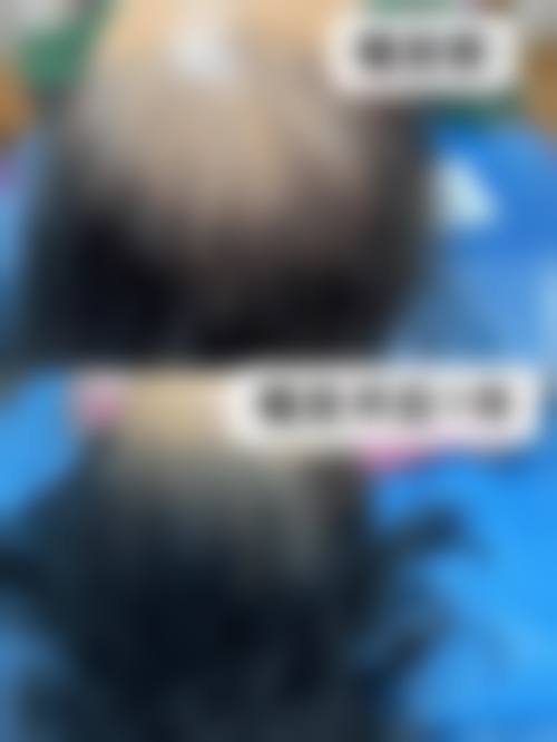 种植头发后期怎么保养？做好清洁护理、饮食调节与日常防护，保障毛囊健康存活