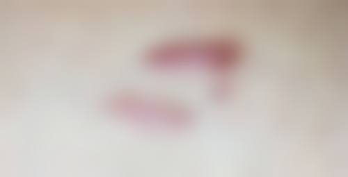 疤痕增生特别痒的手术放疗成效