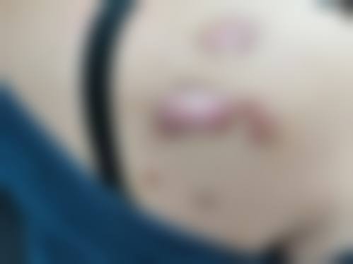 消除疤痕体质胸前疙瘩的日常护理