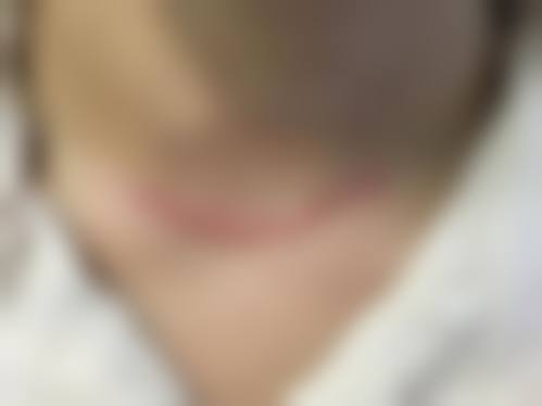 常见的双眼皮手术疤痕修复方法