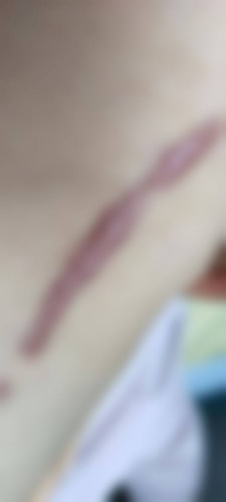 美皮护可以修复旧疤痕吗？| 对增生性等旧疤有改善，需每日贴12小时以上坚持3-6个月