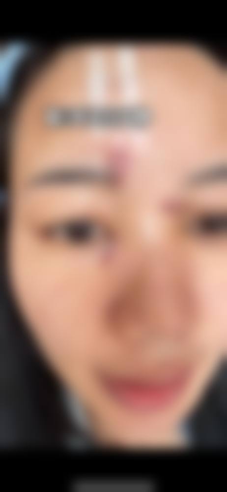 脸部划伤疤痕消失时间与治疗措施