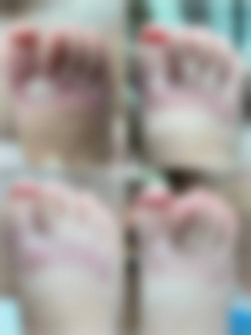 手术治疗疤痕增生疙瘩