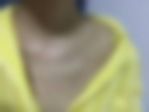 疤痕增生如何消除疙瘩？ 可选用药物、激光、手术联合放疗等个性化治疗方案