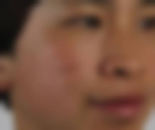 陈旧性手背上烫伤疤痕的处理方案