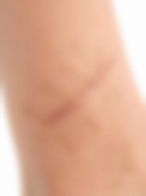 怎样清除擦伤疤痕？分愈合期/早期/成熟期，硅酮产品+光电治疗针对性改善