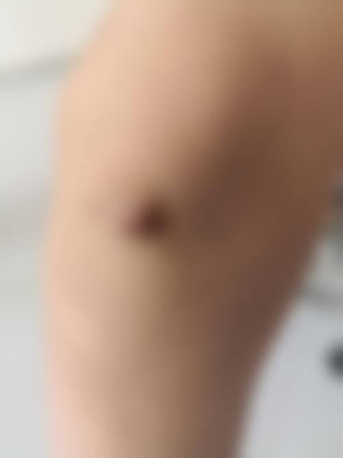 疤痕体质胸前疙瘩的类型与特点