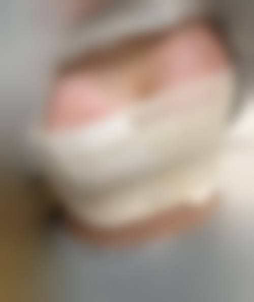 隆胸的假体是什么？主要有硅凝胶、盐水、复合型等材料，需结合胸型、凸度及医生建议选择