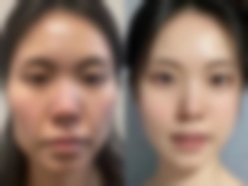精切双眼皮不同修复阶段的表现