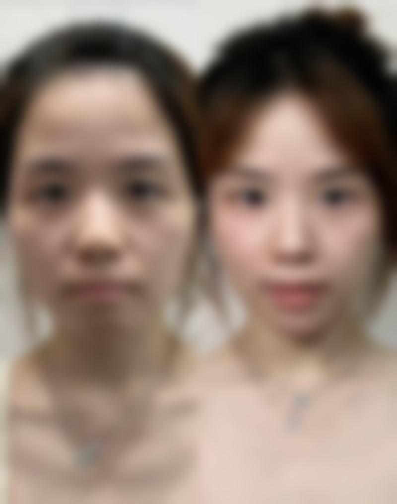 打麻药对瘦脸针成效的影响