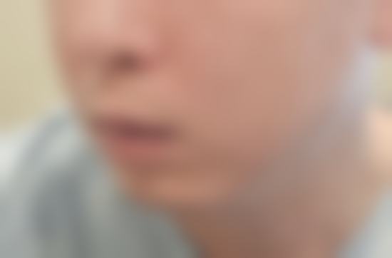 面部轮廓修复:打造精致脸型的魔法
