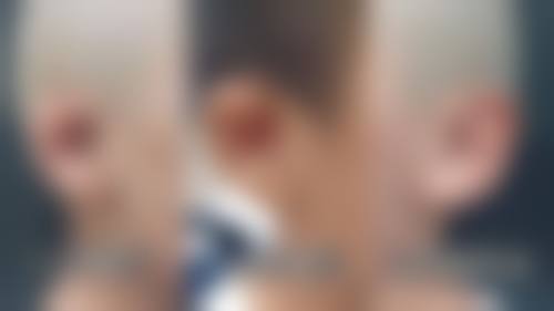 其他治疗方法去除增生性疤痕