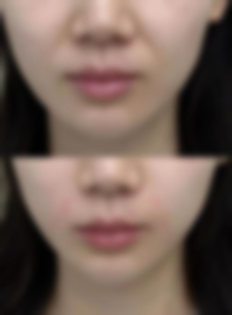 做双眼皮修复期间注意事项