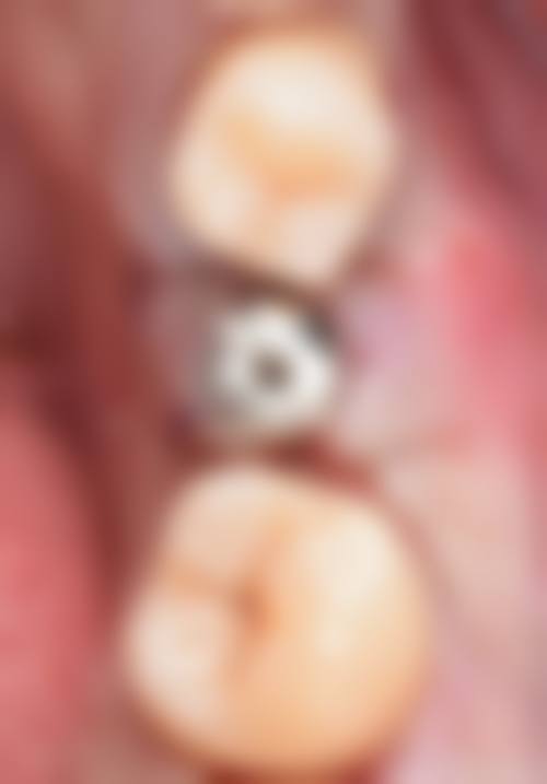 优惠活动详情：高性价比看牙，不止省钱