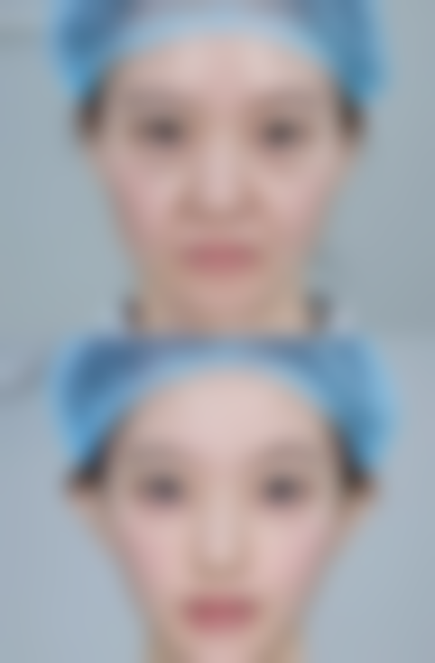 少女针填充法令纹注意事项