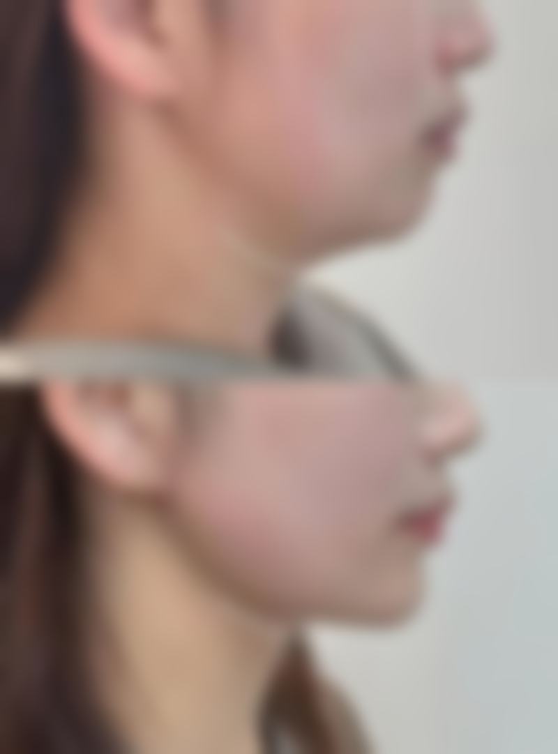 针灸治疗眼袋的注意事项