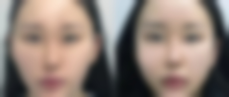成都美容整形医院怎么样：祛眼袋的技术优势
