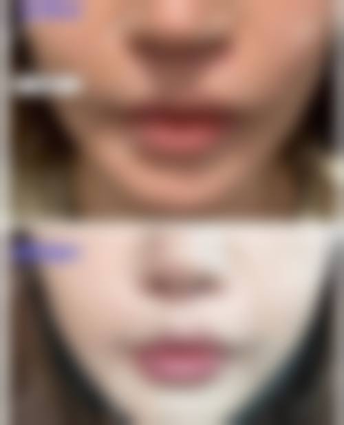 合肥画美医疗美容与爱芙莱胶原蛋白填充相关其他收费参考