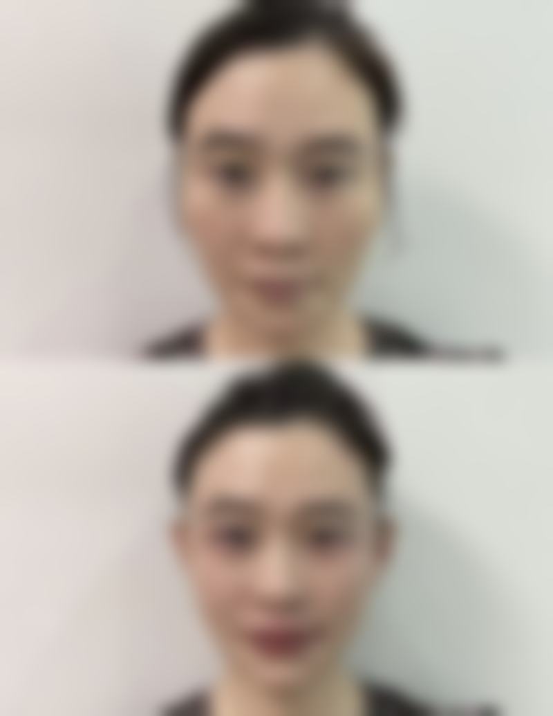 广东广州美恩整形美容医院磨骨特色