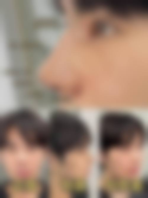 三、佛山壹加壹为鼻修复提供的保护