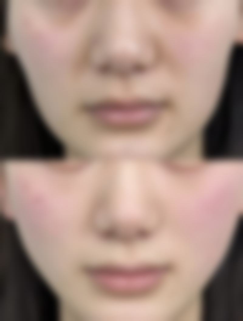 不同激光设备去除疤痕成效对比
